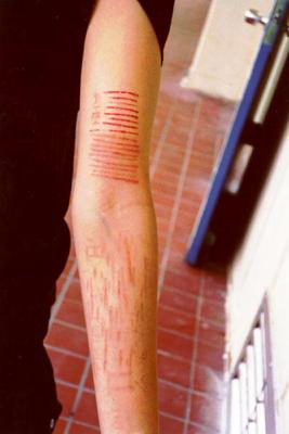 les scarification